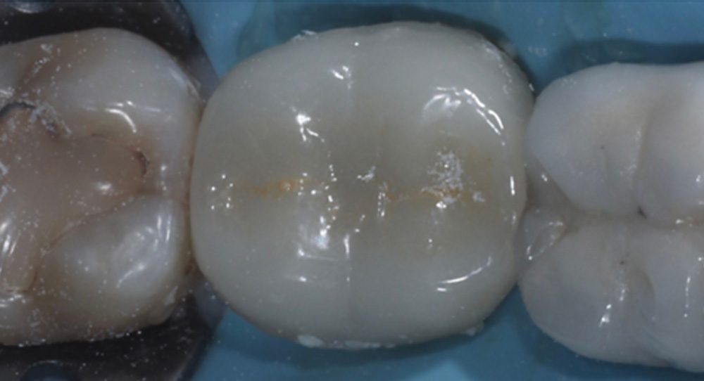 crown-1a
