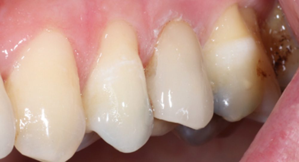 crown-4a