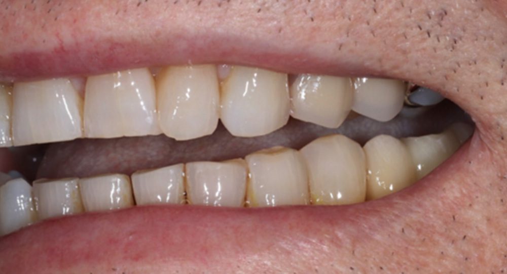 denture-1a