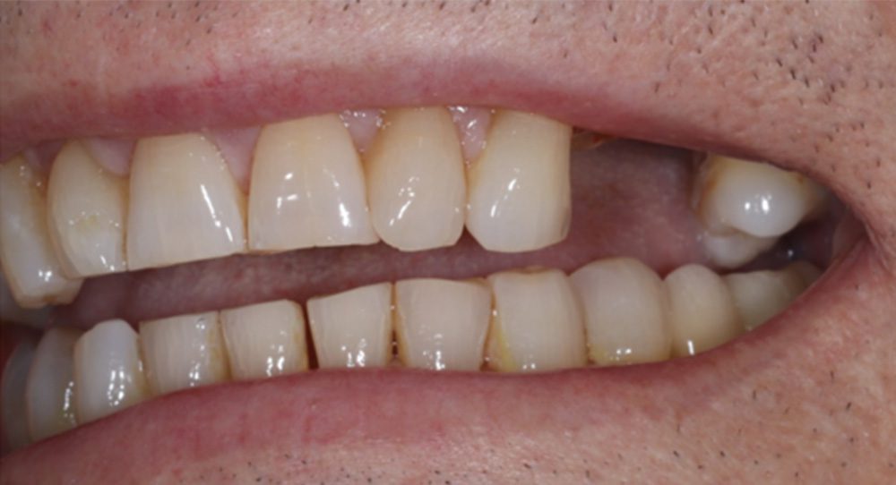denture-1b