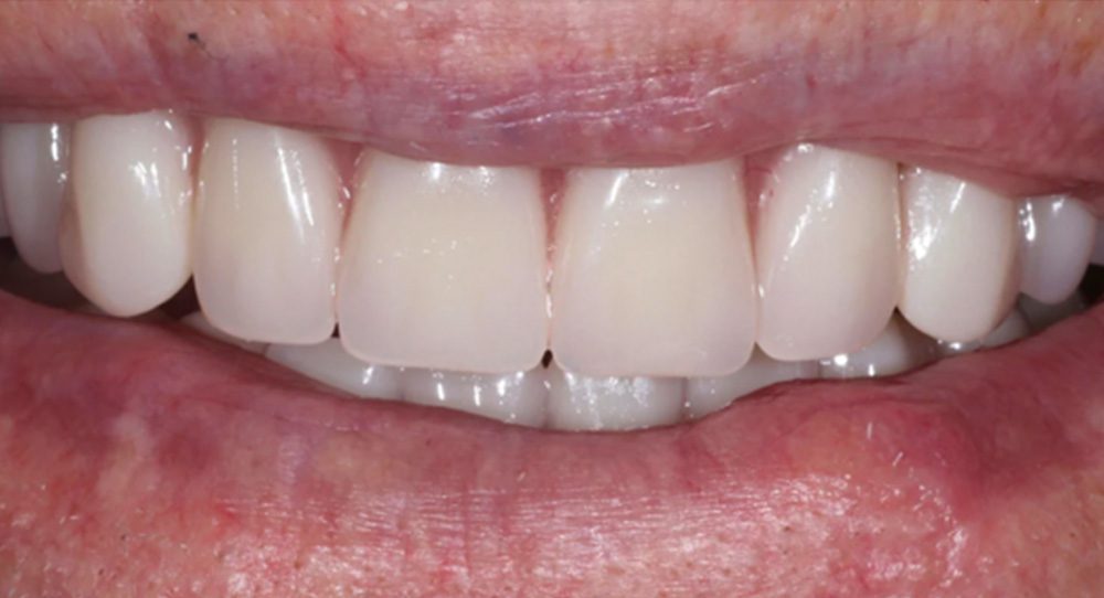 denture-3a