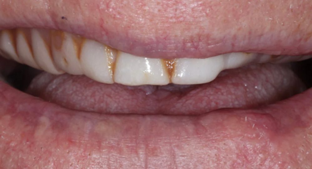denture-3b