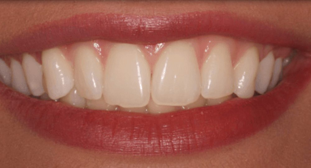 toothwhitening-2a