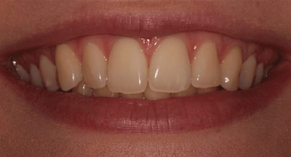 toothwhitening-2b